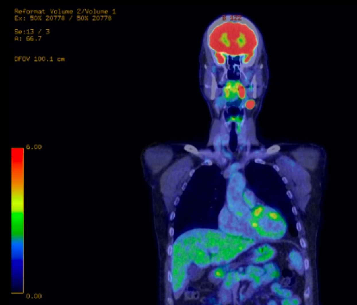 Coronal PET scan of the patient’s head, neck, and chest. Scan shows high FDG uptake in left palatine tonsil and adjacent neck nodes with no visible metastases.